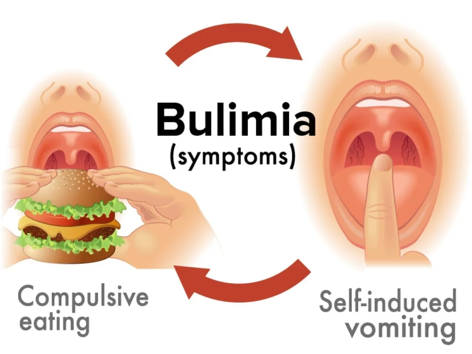 Bulimia Nervosa and Body Image: How the Media Contributes to Eating Disorders